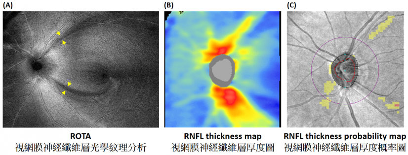 Figure shows superotemporal and inferotemporal retinal nerve fibre layer defects detected by ROTA (yellow arrows) (A) in a patient with early glaucoma that are missed by conventional retinal nerve fibre layer thickness analysis (B and C) – the current clinical standard for detection of glaucoma.
 